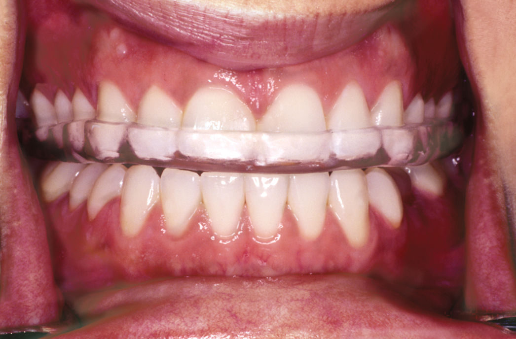 Comfort H/S™ Bite Splints DigiTech Dental Restorations